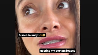 BRACES UPDATE Getting bottom braces Canine tooth coming in ‼️🦷🤓 braces bracesjourney braceface [upl. by Lymn]