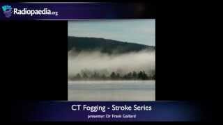 Stroke Fogging phenomenon on CT  radiology video tutorial [upl. by Leibman5]