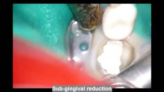 Treatment of primary molar with NuSmile ZR crown [upl. by Odnama218]