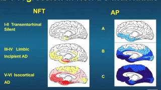 Dr Linda Ercoli quotNeuroimaging in Down syndromequot [upl. by Joline]