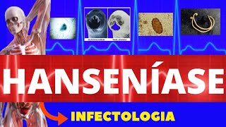 HANSENÍASE  CAUSA SINTOMAS DIAGNÓSTICO E TRATAMENTO  INFECTOLOGIA [upl. by Airogerg150]