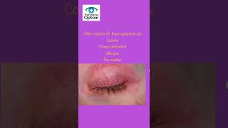 Blepharitis Symptoms Explained 👁️  eyes Rubbing Watering amp More optician [upl. by Meilen725]