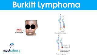 Burkitts LymphomaCauses  Symptoms and Treatment [upl. by Sparke543]