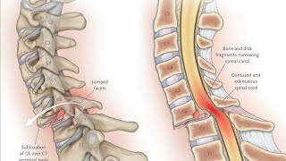 spinal cord compression  disc prolapse and trumatic nerve injury [upl. by Annais]