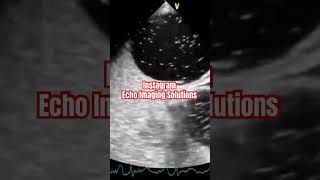 Patent Foramen Ovale echocardiography echocardiogram cardiology [upl. by Latyrc]