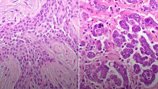 Pleural Mesothelioma [upl. by Sessler469]