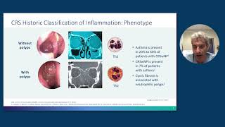 Rhinosinusitis With Nasal Polyps From Pathophysiology to Management [upl. by Mintun]