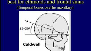 PNS and Caldwell view anatomy and position [upl. by Chellman501]