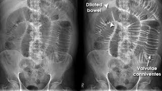 X ray of Small Bowel Obstruction [upl. by Prudi41]