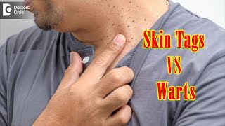 What Causes Skin Tags And Warts  Get Rid of Warts amp Skin Tags Dr Renuka Shetty  Doctors Circle [upl. by Sacks]