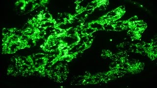 Nephritic syndrome and post infectious glomerulonephritis  Pathology mini tutorial [upl. by Dalis]