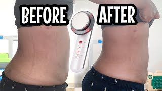 Ultrasonic Fat Cavitation Before And After  Fat Cavitation Before And After Results  AMAZING [upl. by Kohcztiy]