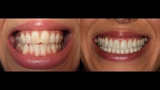 Invisalign Time Lapse UPDATED [upl. by Ober]