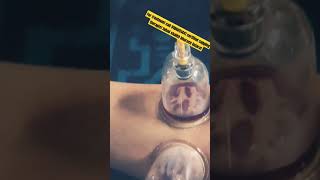 hijamacuppingtherapy hijamabenefits hijama hijamatreatment youtubeshorts ayurveda science [upl. by Ffej804]