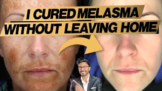 Melasma Treatment At Home Expert Doctors 3 Easy Steps  before and after [upl. by Searcy875]