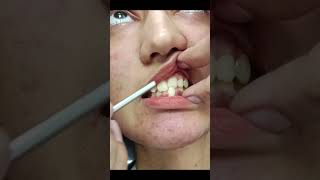 The Easy Way to Fix Cross Bite Without Surgery [upl. by Niwrud]