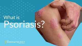 What Is Psoriasis [upl. by Gabrielson]