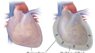 My Pericarditis or Heart Fluid Buildup I think it was caused by an infection It happened suddenly [upl. by Nagah]