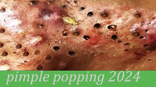 pimple popping 2024 new blackheads on nose pimple popping tiktok 4332 [upl. by Braasch]