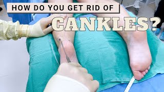 Get Rid of Cankles with High Definition Calf Liposuction  Barrett Plastic Surgery [upl. by Darnoc]