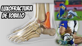 LUXOFRACTURA DE TOBILLO futbol fractura [upl. by Afatsom252]