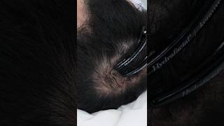 Treating Thinning Hair with Exosome Therapy [upl. by Tevis]