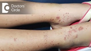 How to manage itchy skin amp small black spots on arms amp legs in 3 year old  Dr Varsha Saxena [upl. by Nonez]