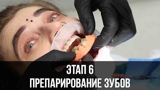 Этап 6 Препарирование зубов под виниры [upl. by Egdamlat]