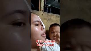 Rhinoplasty nice result funny comedyfilms funnycomedy forintertaintmentonly comedymovies [upl. by Jenine]