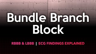 Left and Right Bundle Branch Block ECG Made Easy [upl. by Embry427]