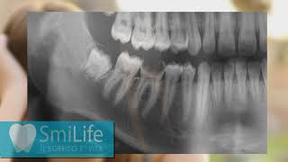 Trattamento Endodontico Cura Canalare o Devitalizzazione [upl. by Idnor731]