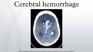 Cerebral hemorrhage [upl. by Ayrad]