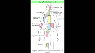 Virchows Node Abdominal Metastasis [upl. by Nwahsem]