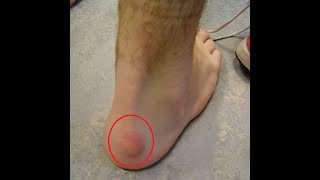 Bump on my Foot Is It A Ganglion or Fibroma [upl. by Eetnod]