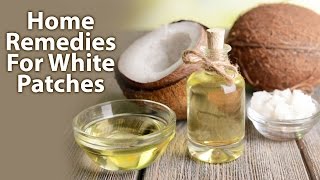 Home Remedies For White PatchesLeucoderma [upl. by Elijah]