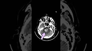 Pontine hemorrhage [upl. by Bradleigh]