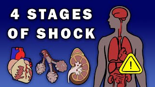 THE 4 STAGES OF SHOCK [upl. by Eruza]