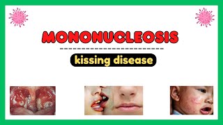 Mononucleosis infection epstein barr virus pathophysiology symptoms diagnosis treatment [upl. by Katzman620]