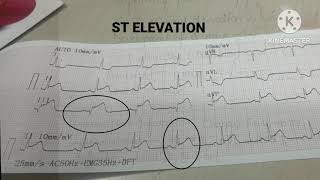 MYOCARDIAL INFARCTIONMIACUTE CORONAY SYNDROME [upl. by Jeth857]