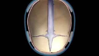 Sagittal Synostosis Helmet Therapy  Craniosynostosis Surgery [upl. by Esilec311]