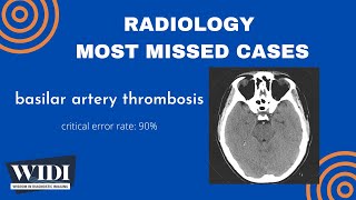 Most Missed Cases Basilar Artery Thrombosis [upl. by Yecart]