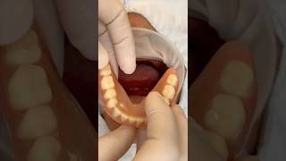 전체임플란트 임시치아 full implant temporary dental dentist immediateloading [upl. by Anawt677]