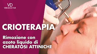 Crioterapia rimozione con azoto liquido di cheratosi attiniche [upl. by Hobard]