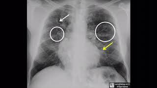 Cystic Fibrosis [upl. by Ioab]