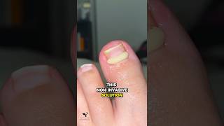 NonSurgical Treatment for Ingrown Toenail [upl. by Archibold]