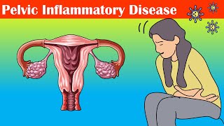 Pelvic Inflammatory Disease PID  Causes Signs amp Symptoms Diagnosis And Treatment [upl. by Karry170]