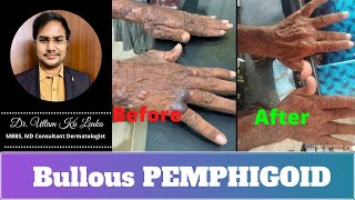 Bollous pemphigoid large blisters on skin causes  boro foska chamrai  Dr Uttam lenka [upl. by Ella528]