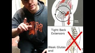 How To Fix Anterior Pelvic Tilt  NEVER SEEN SOLUTIONS  Shorter Leg amp Orthotics Considerations [upl. by Sension]