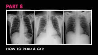 Diaphragms and Pleural Effusion  How to Read a Chest XRay Part 8  MEDZCOOL [upl. by Schulze409]