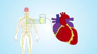 Be still my beating heart – Slowing an overexcited heart rate with epidural anesthesia [upl. by Adama]